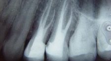 Radiografia de dentes com tratamento de canal