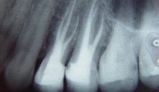 Radiografia de dentes com tratamento de canal