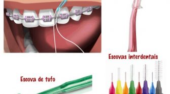 Tudo o que você precisa para escovar o dentes usando aparelho