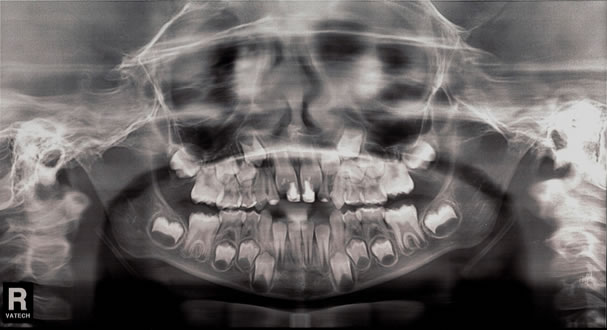 Radiografia panorâmica de dentição mista